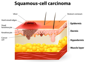 squamous
